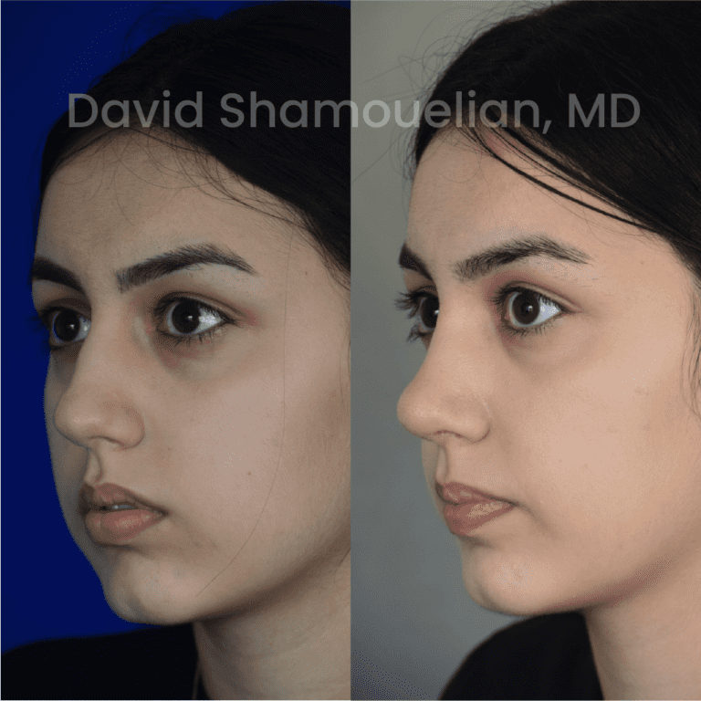 Allure BH Before After Rhino Pt 39