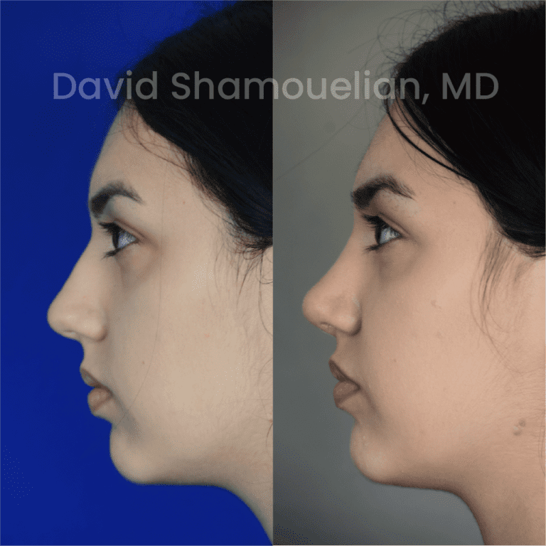 Allure BH Before After Rhino Pt 39