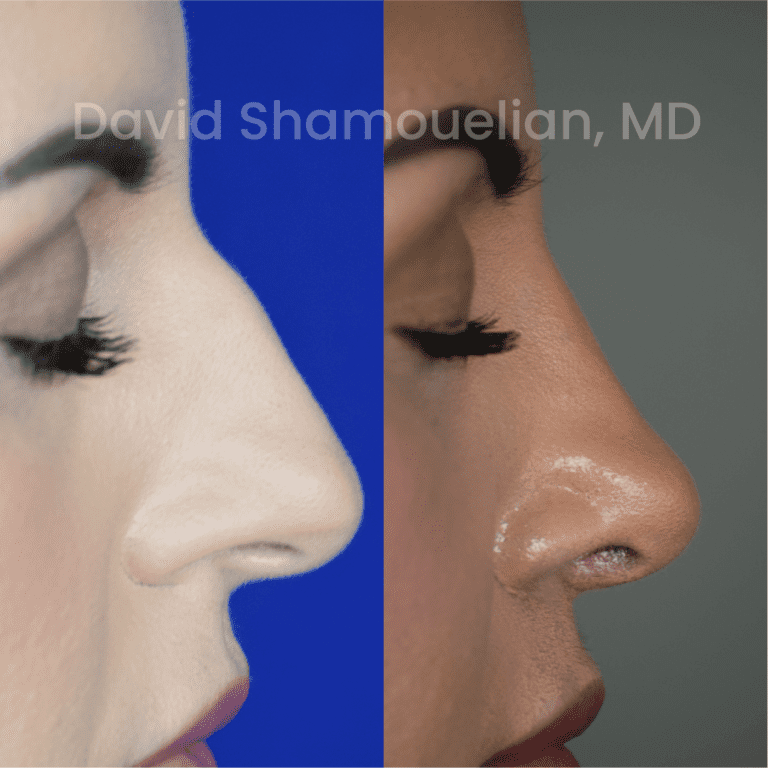 Allure BH Before After Rhino Pt 40