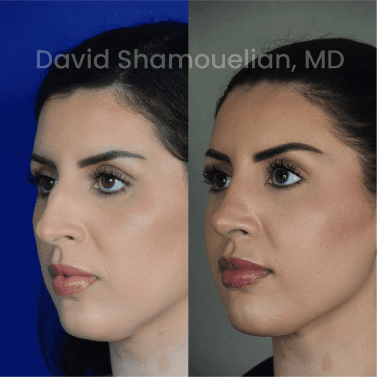 Allure BH Before After Rhino Pt 40