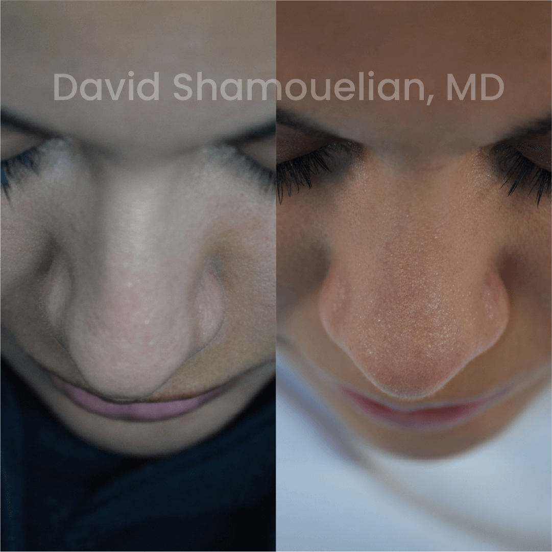 Allure BH Before After Rhino Pt 23