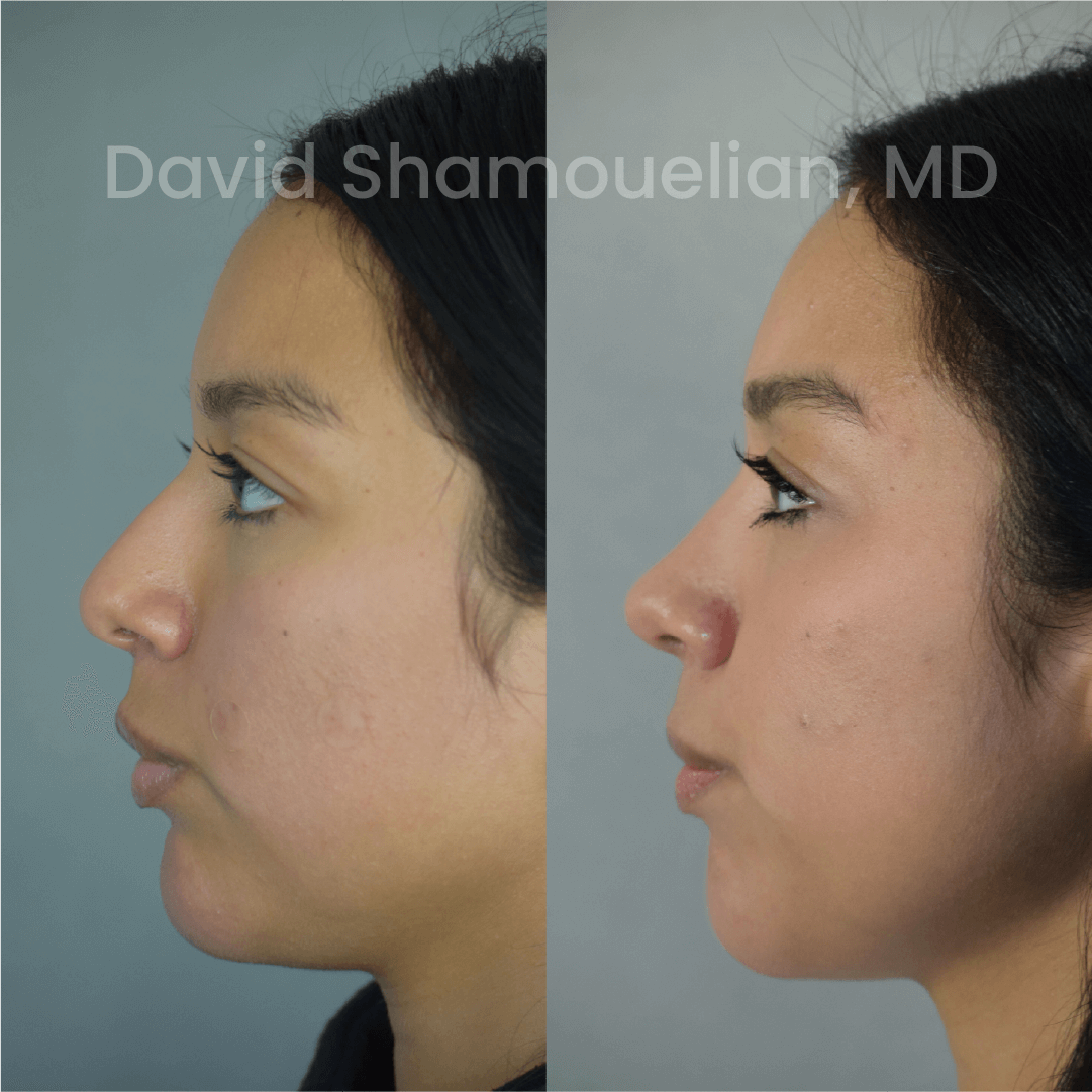 Allure BH Before After Rhino Pt 23