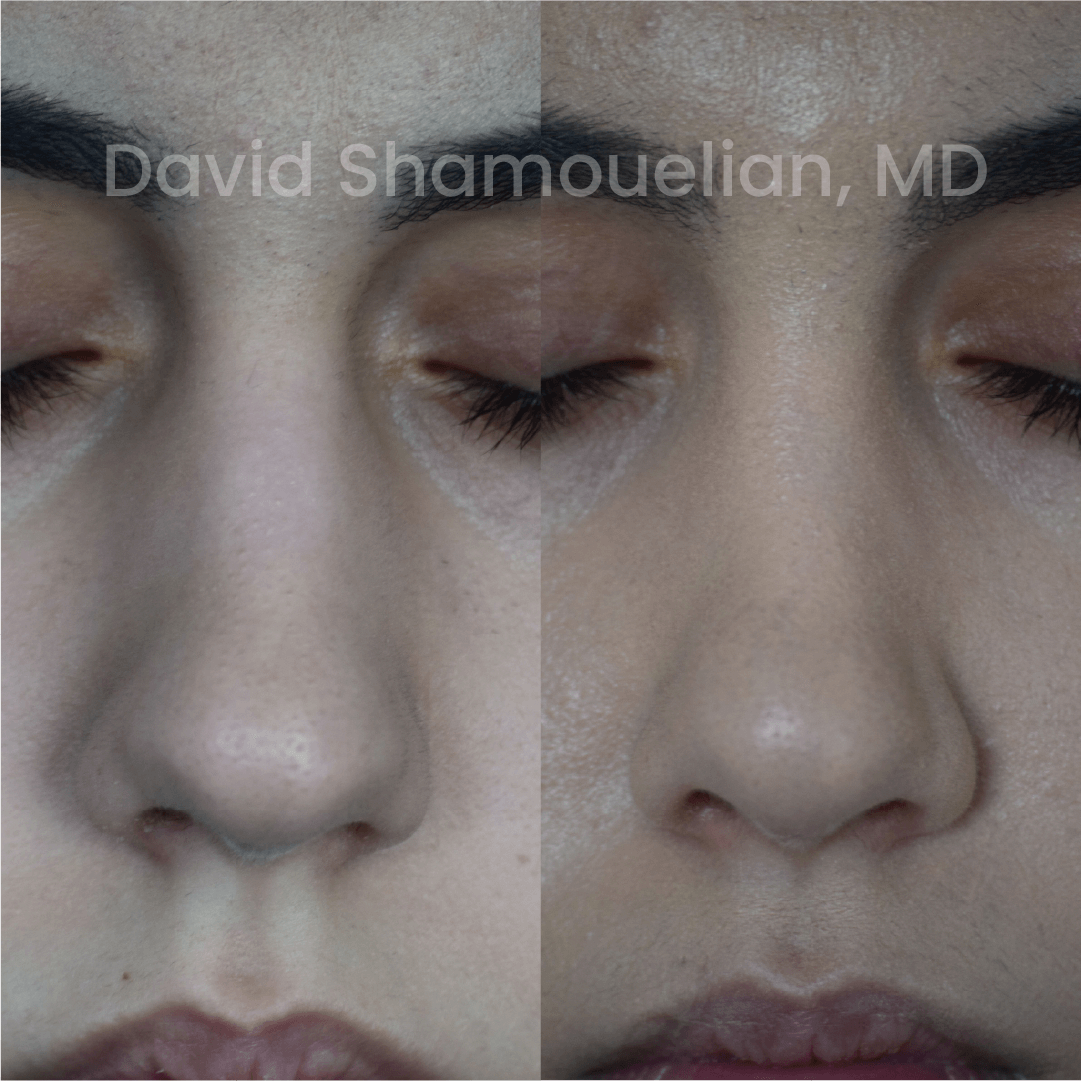 Allure BH Before After Rhino Pt 46