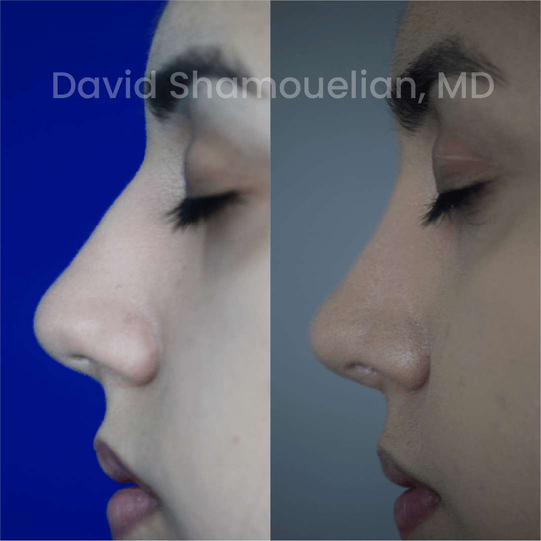 Allure BH Before After Rhino Pt 46