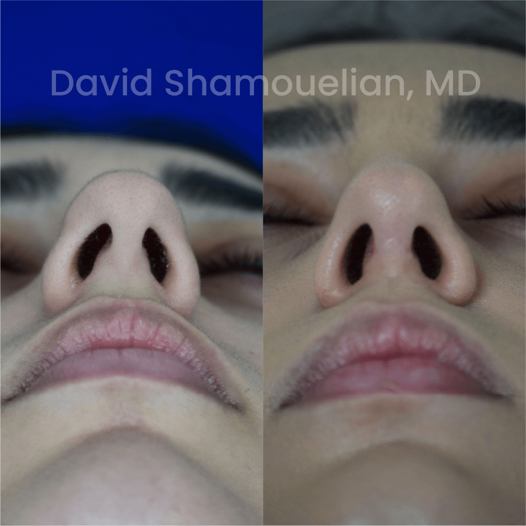 Allure BH Before After Rhino Pt 46