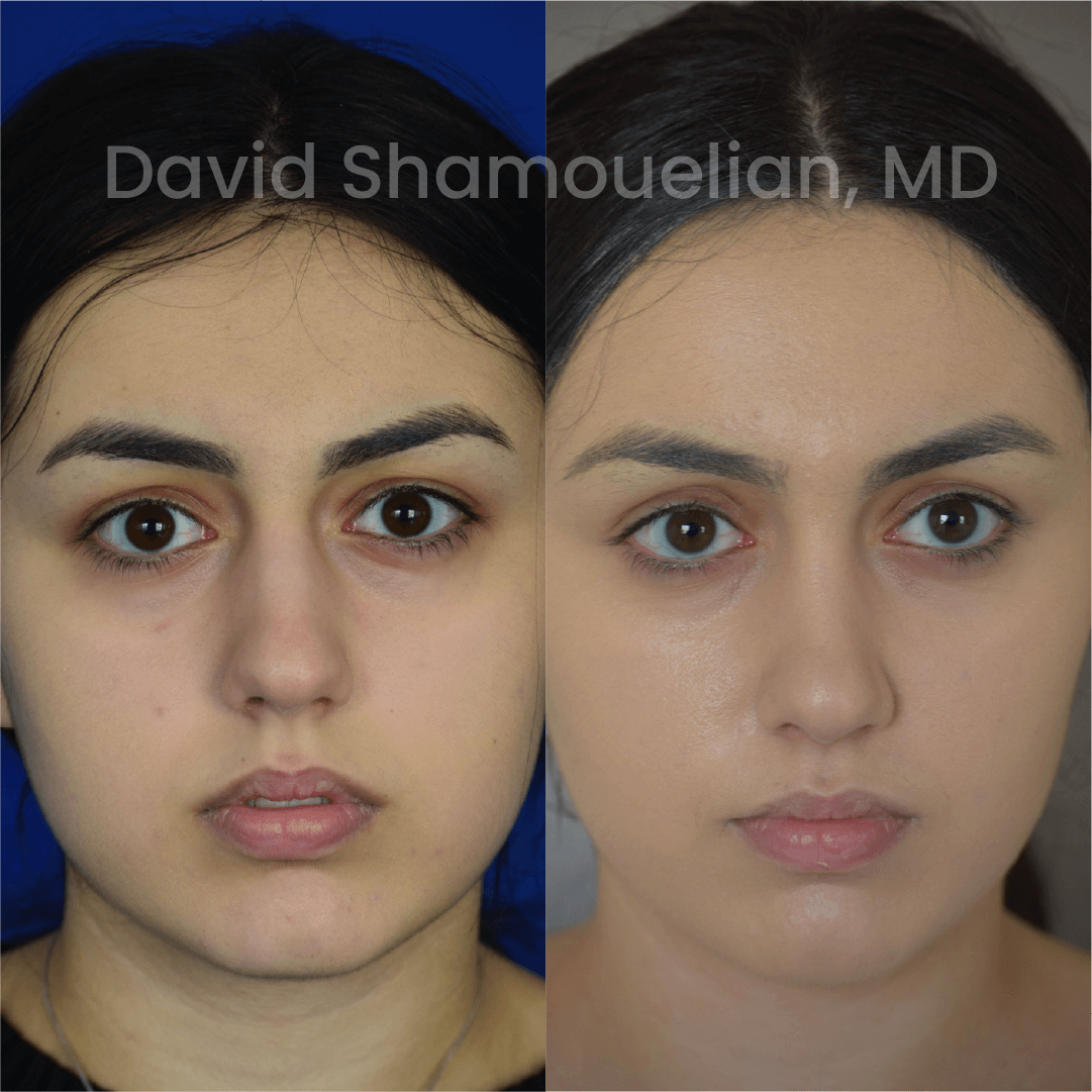 Allure BH Before After Rhino Pt 46