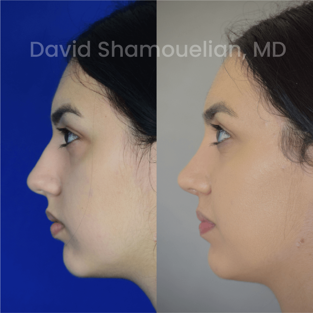 Allure BH Before After Rhino Pt 46