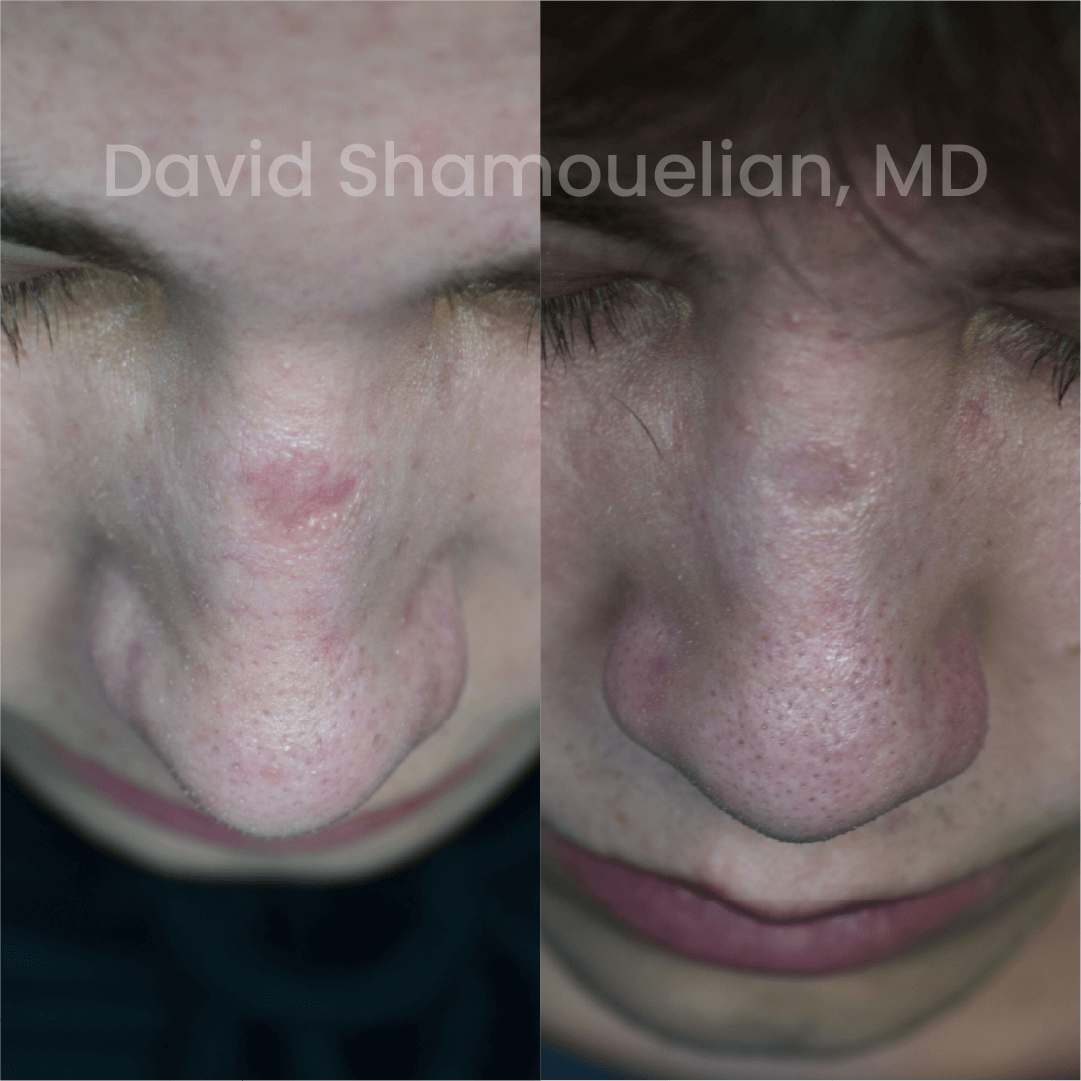 Allure BH Before After Rhino Pt 47