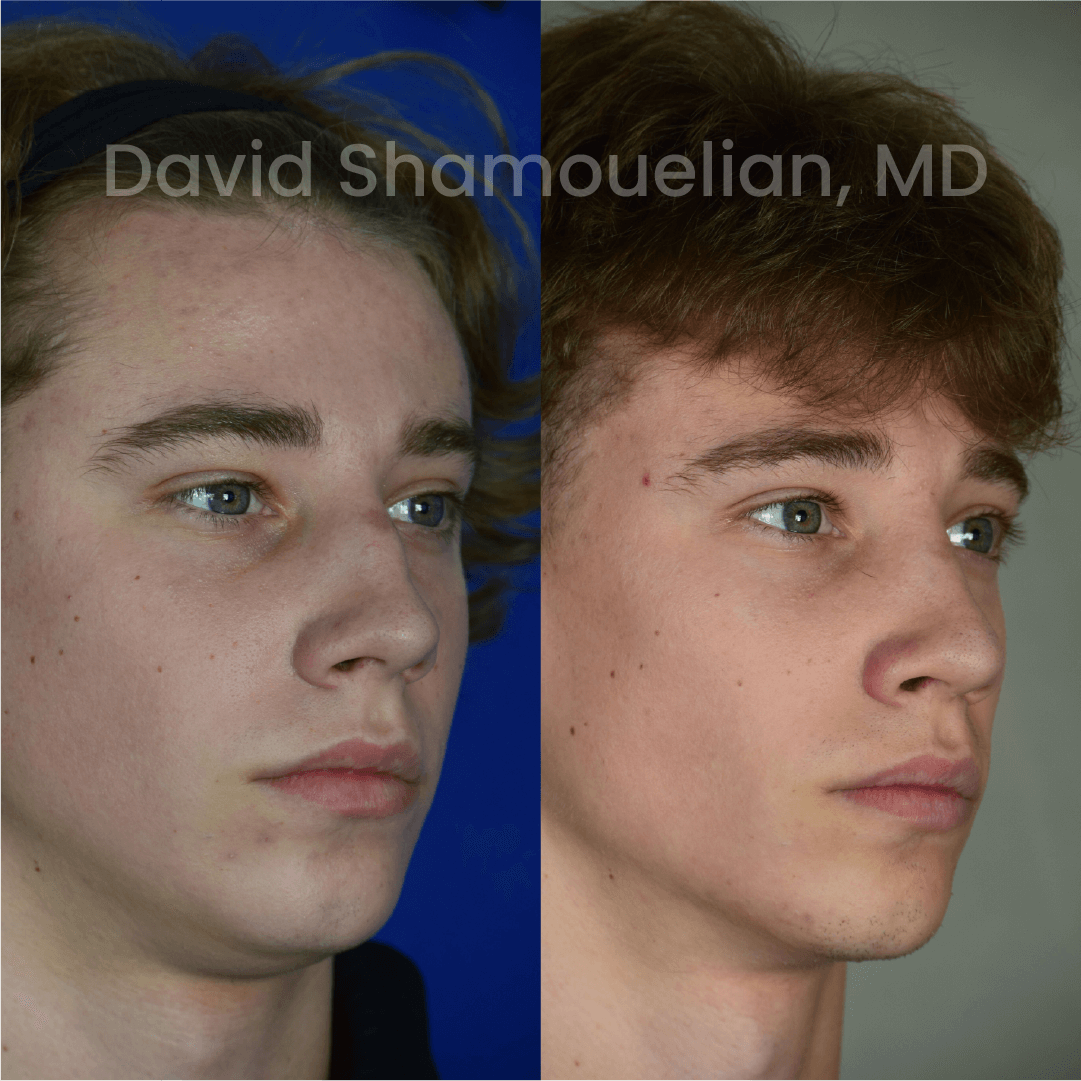 Allure BH Before After Rhino Pt 47