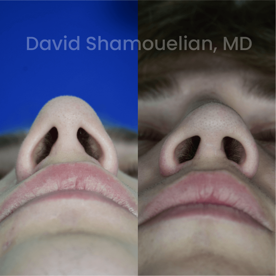 Allure BH Before After Rhino Pt 47