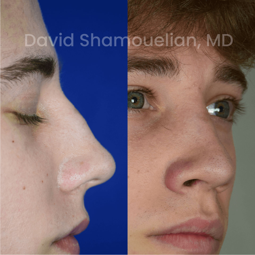 Allure BH Before After Rhino Pt 47