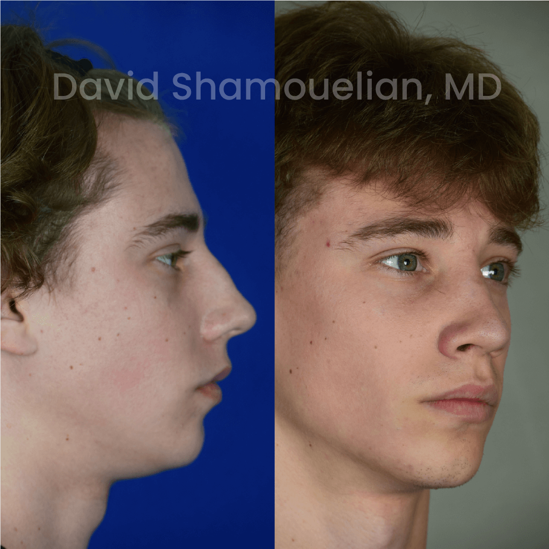 Allure BH Before After Rhino Pt 47