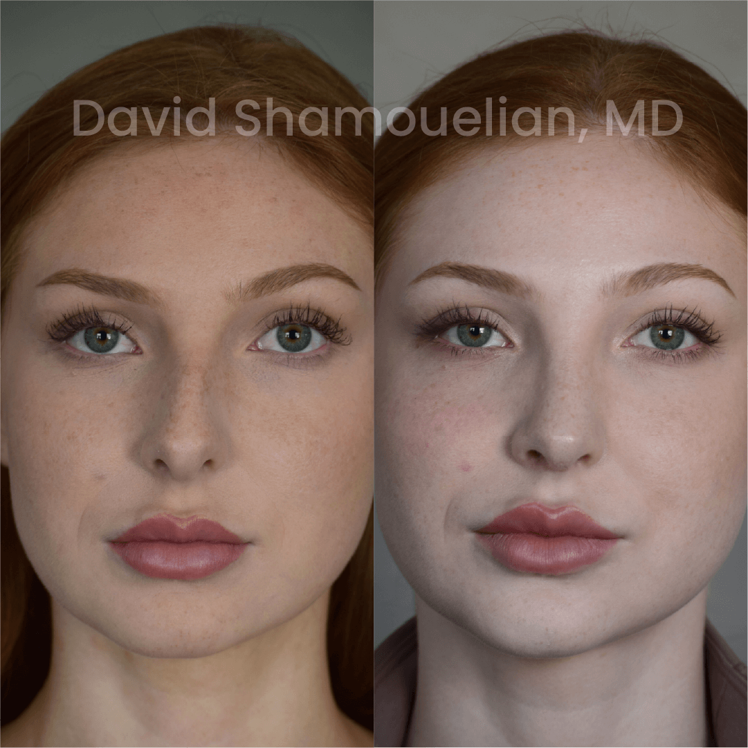 Allure BH Before After Rhino Pt 48