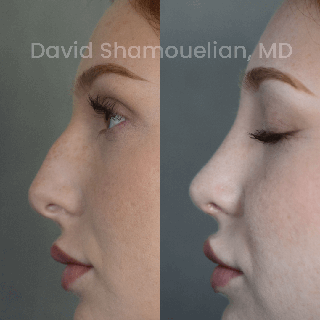 Allure BH Before After Rhino Pt 48