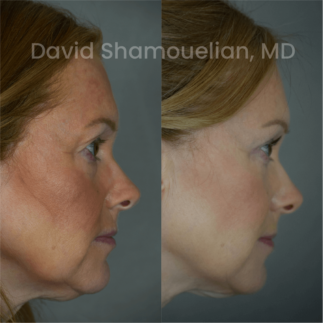 Allure BH Before After Rhino Pt 49