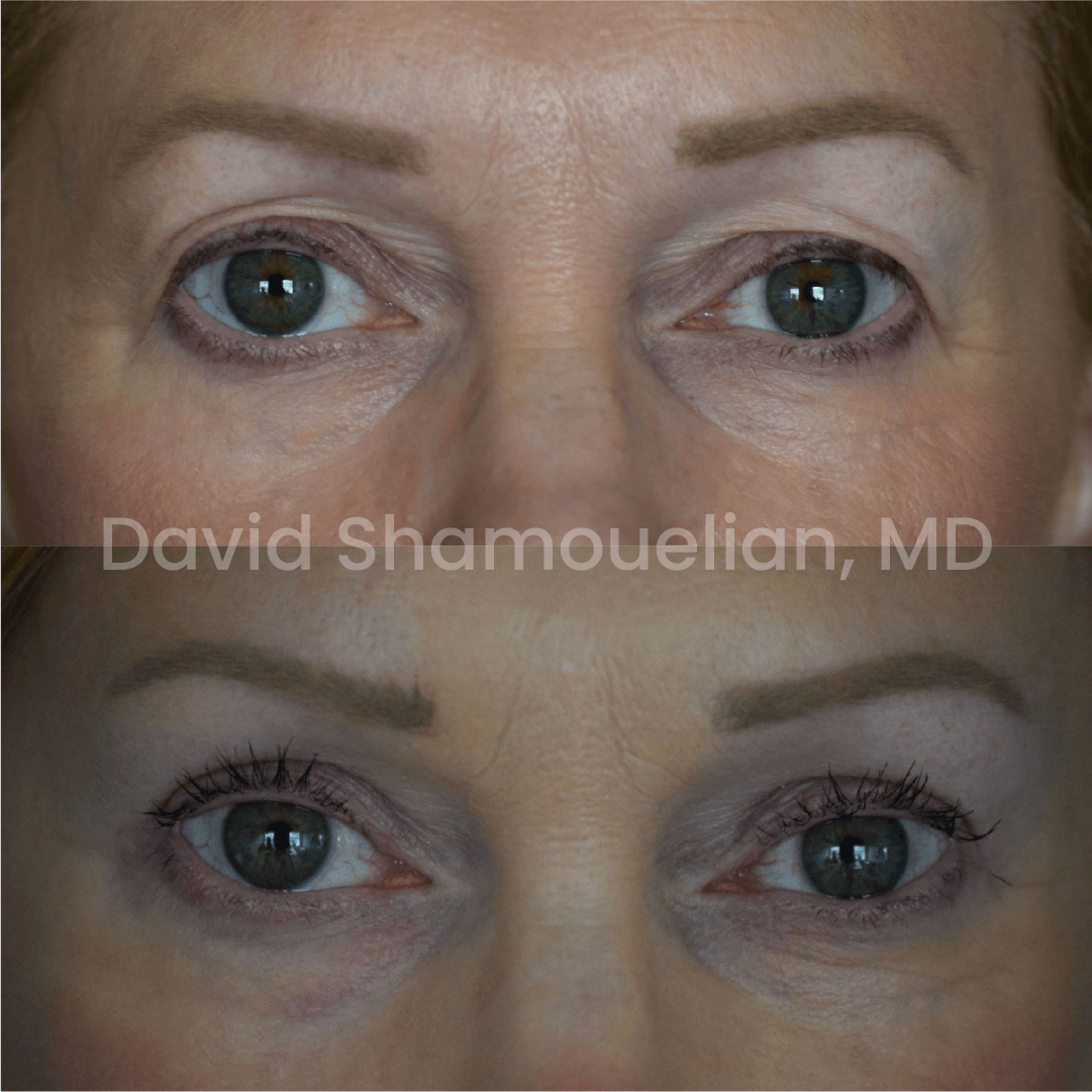 Allure BH Before After Rhino Pt 49