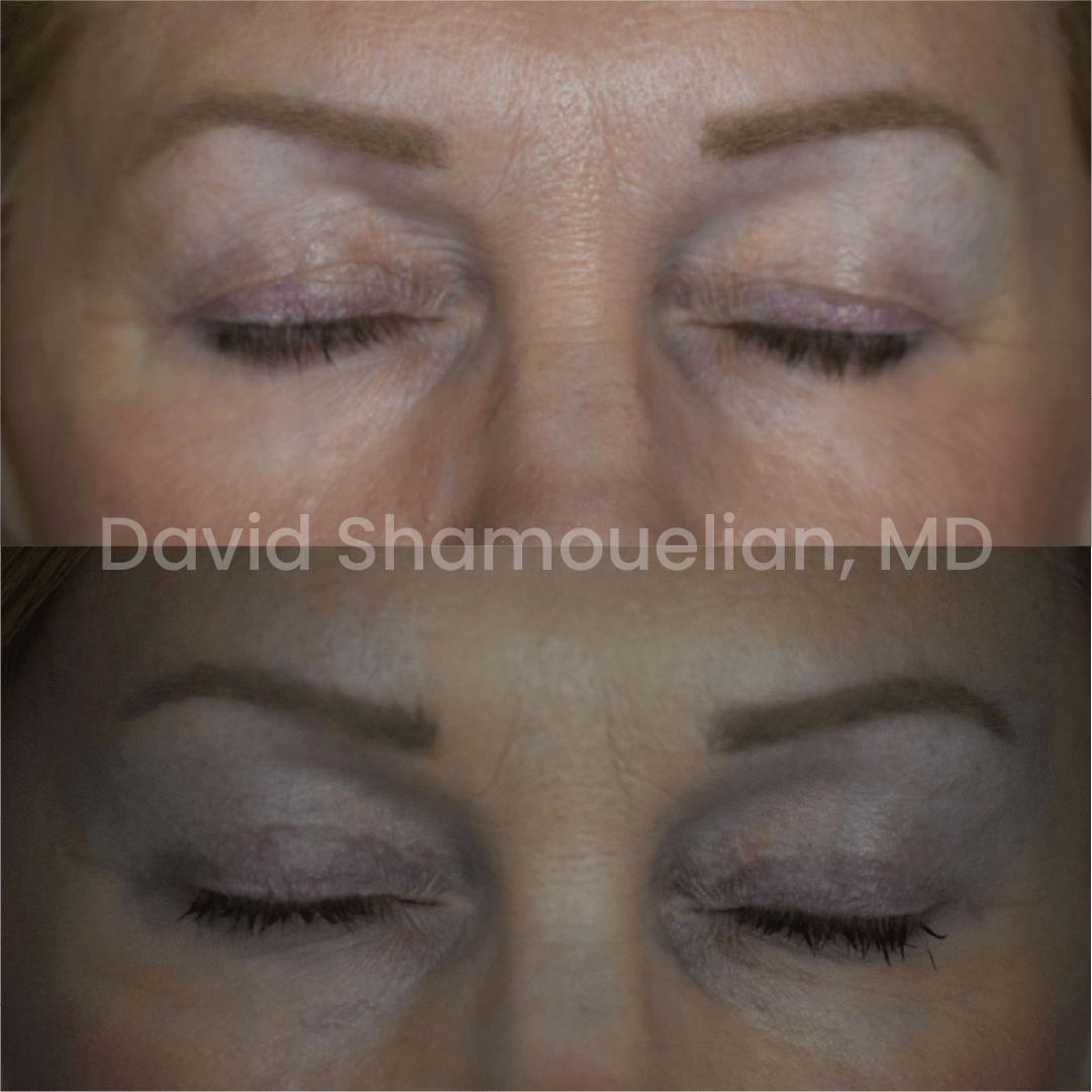 Allure BH Before After Rhino Pt 49