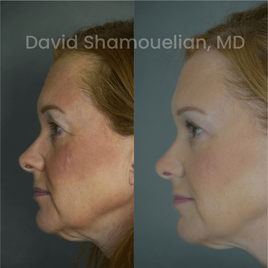 Allure BH Before After Rhino Pt 49