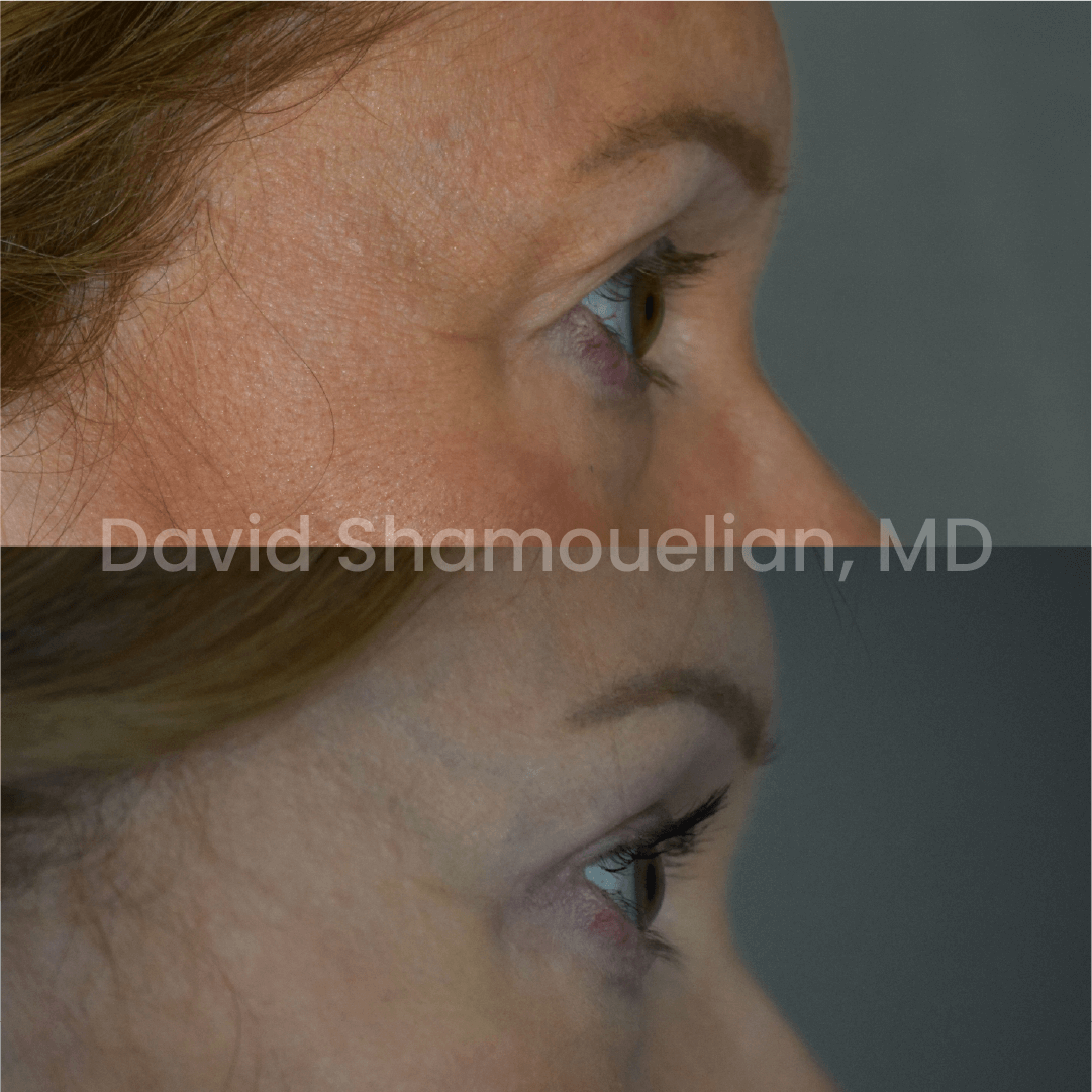 Allure BH Before After Rhino Pt 49