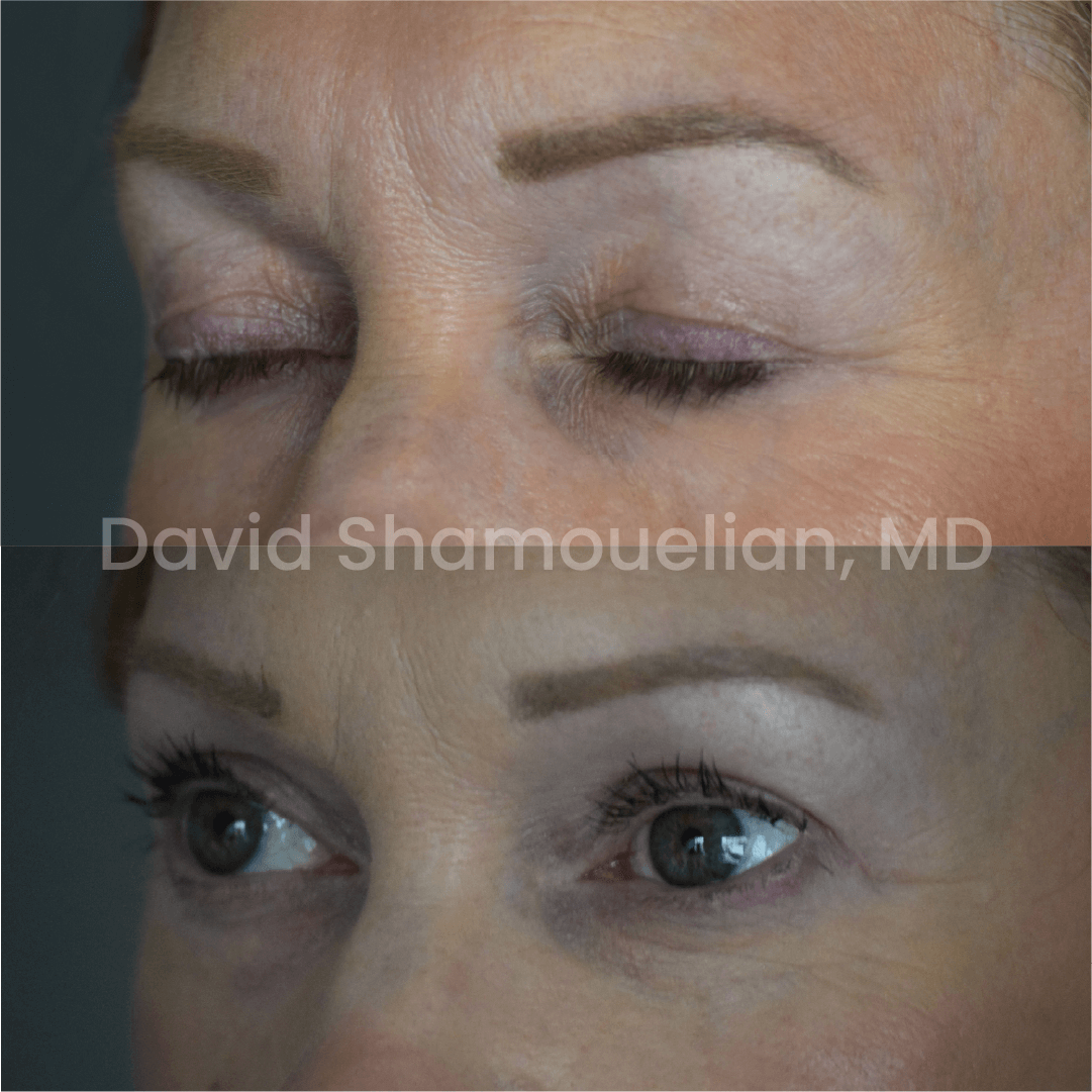 Allure BH Before After Rhino Pt 49-12