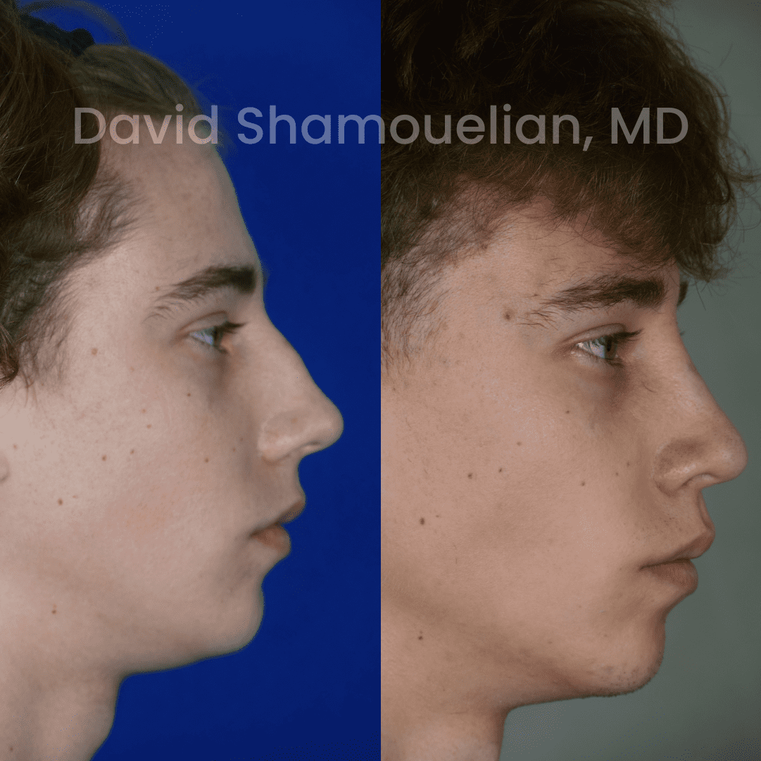 Allure BH Before After Rhino Pt 47-11