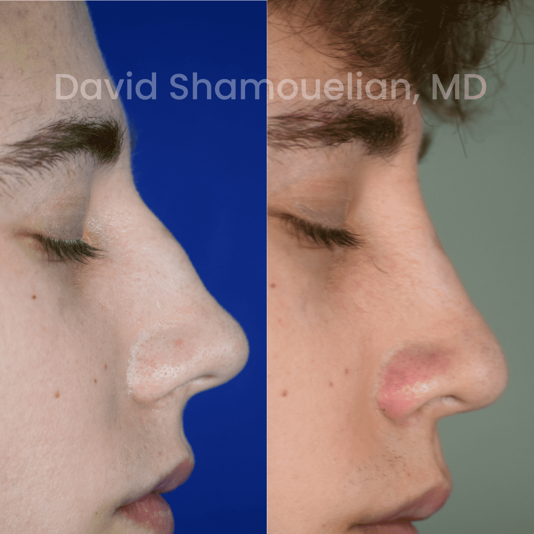 Allure BH Before After Rhino Pt 47-12