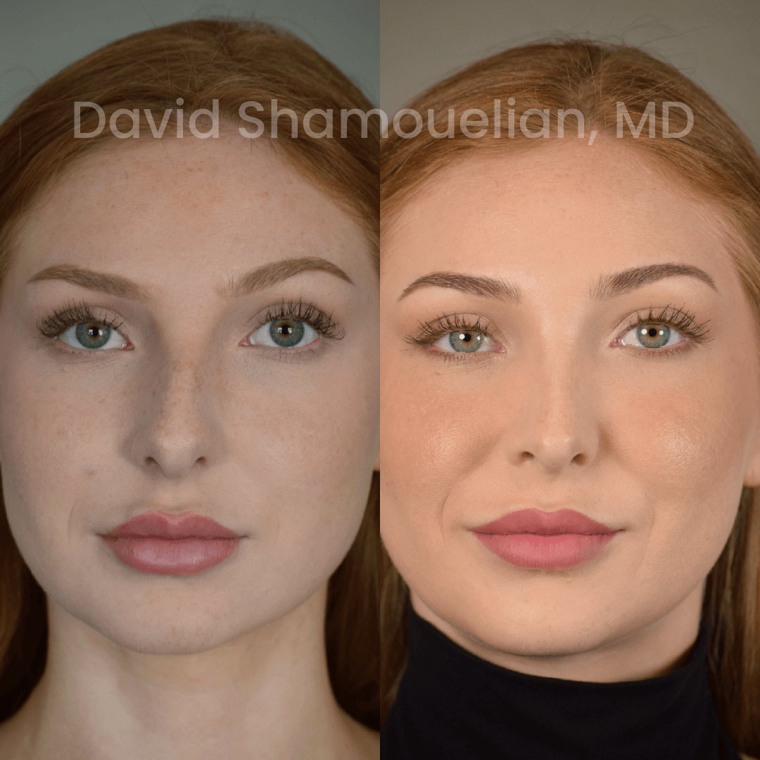 Allure BH Before After Rhino
