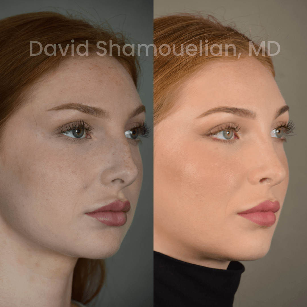 Allure BH Before After Rhino