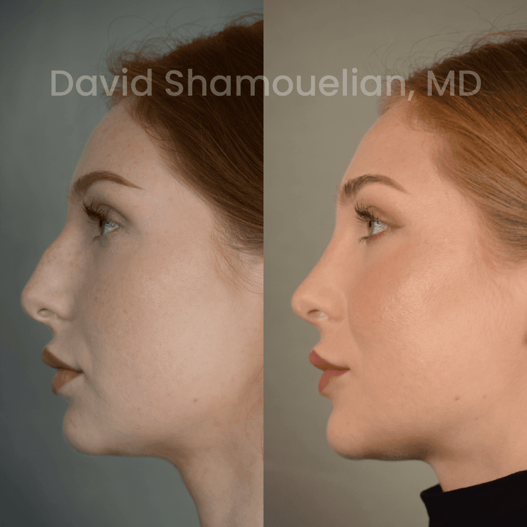 Allure BH Before After Rhino Pt 42-05