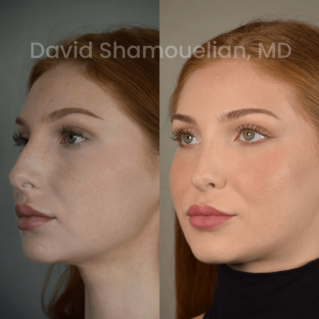 Allure BH Before After Rhino Pt 42-10