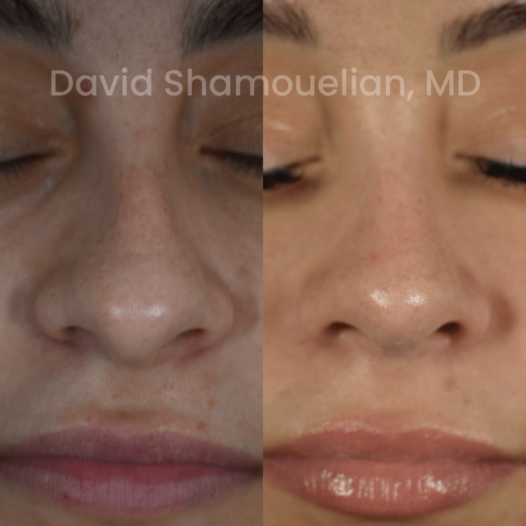 Allure BH Before After Rhino Pt 50