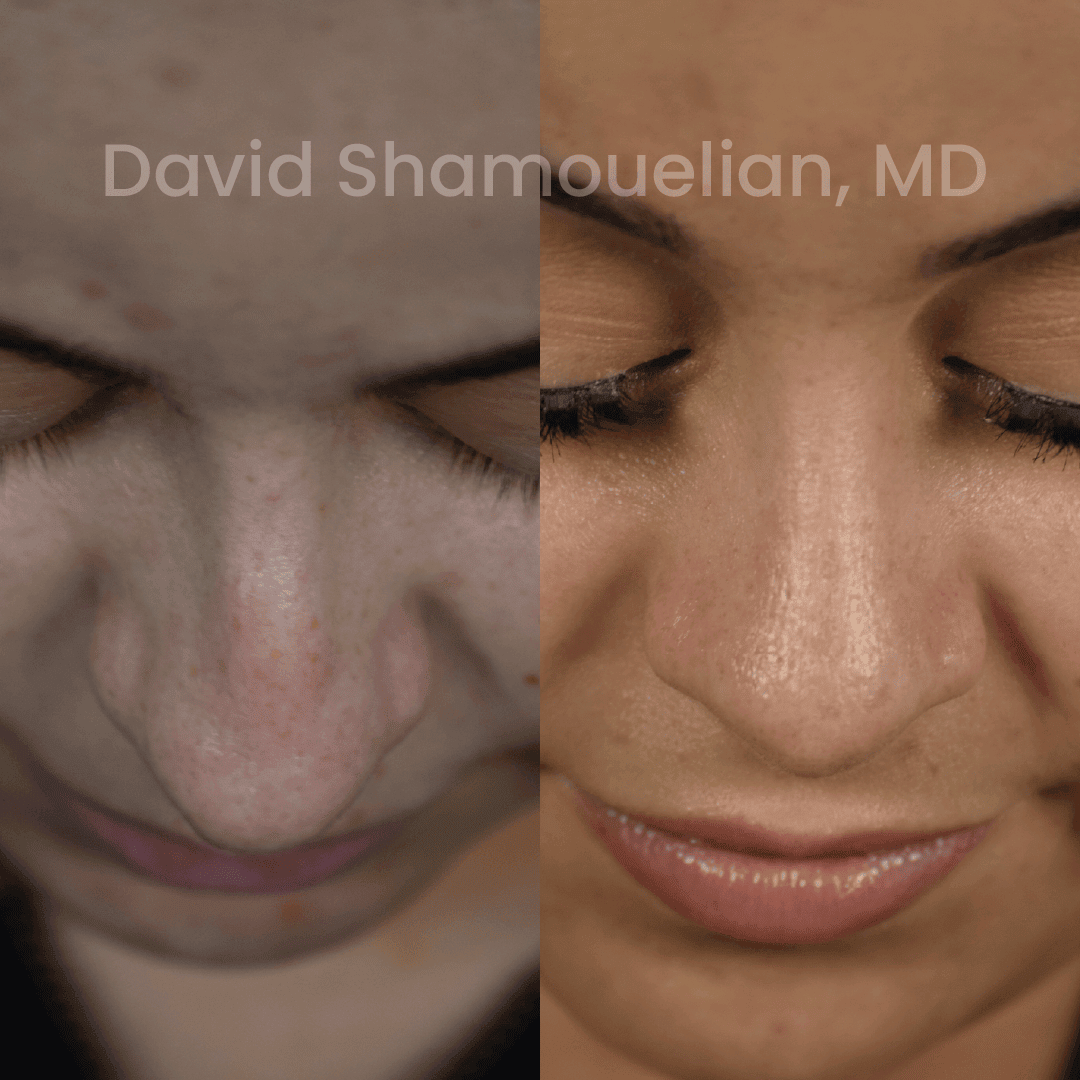 Allure BH Before After Rhino Pt 50