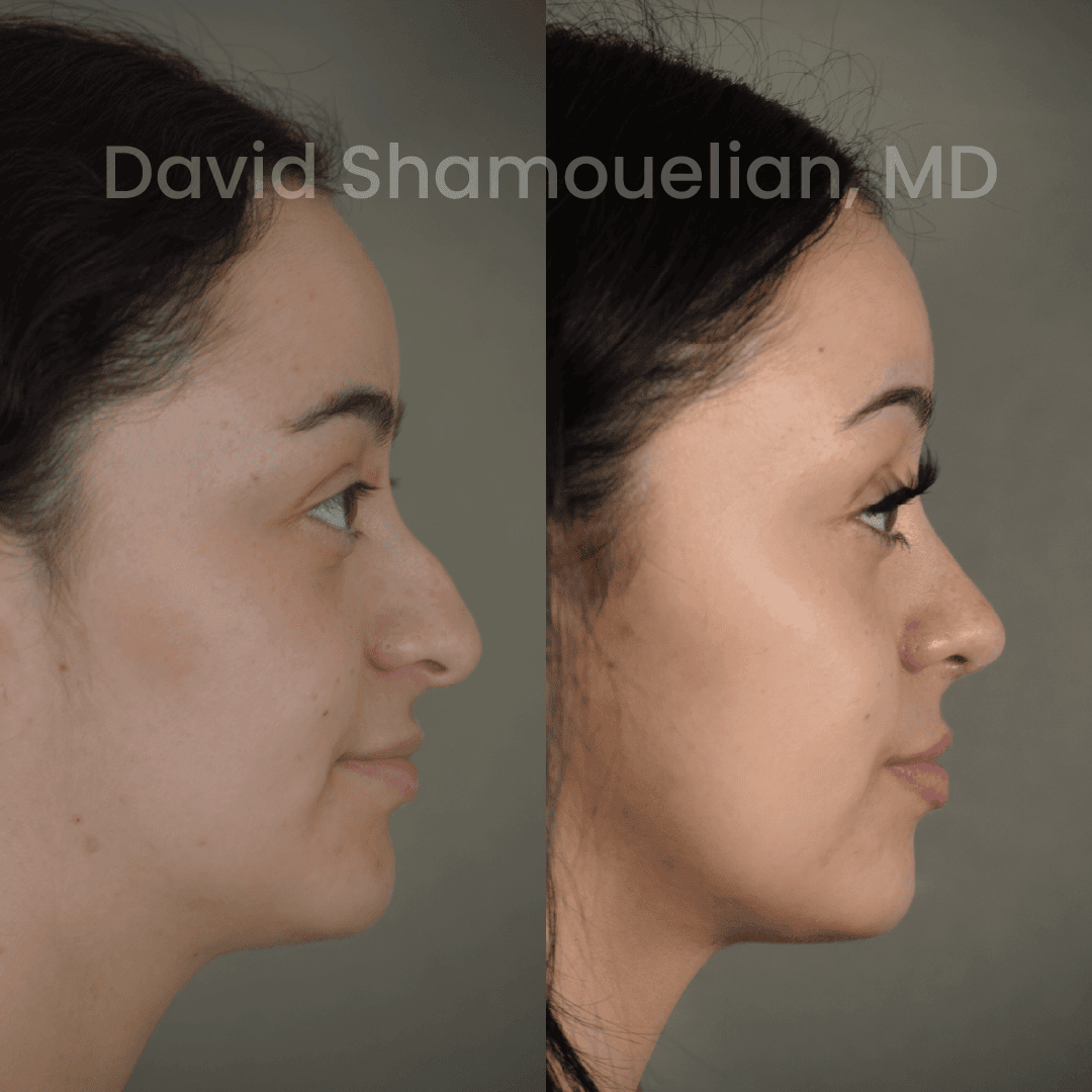 Allure BH Before After Rhino Pt 50