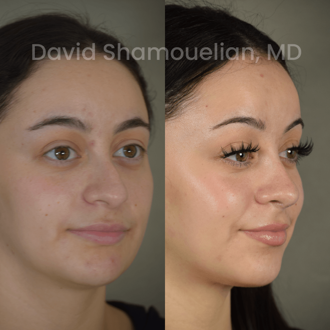 Allure BH Before After Rhino Pt 50