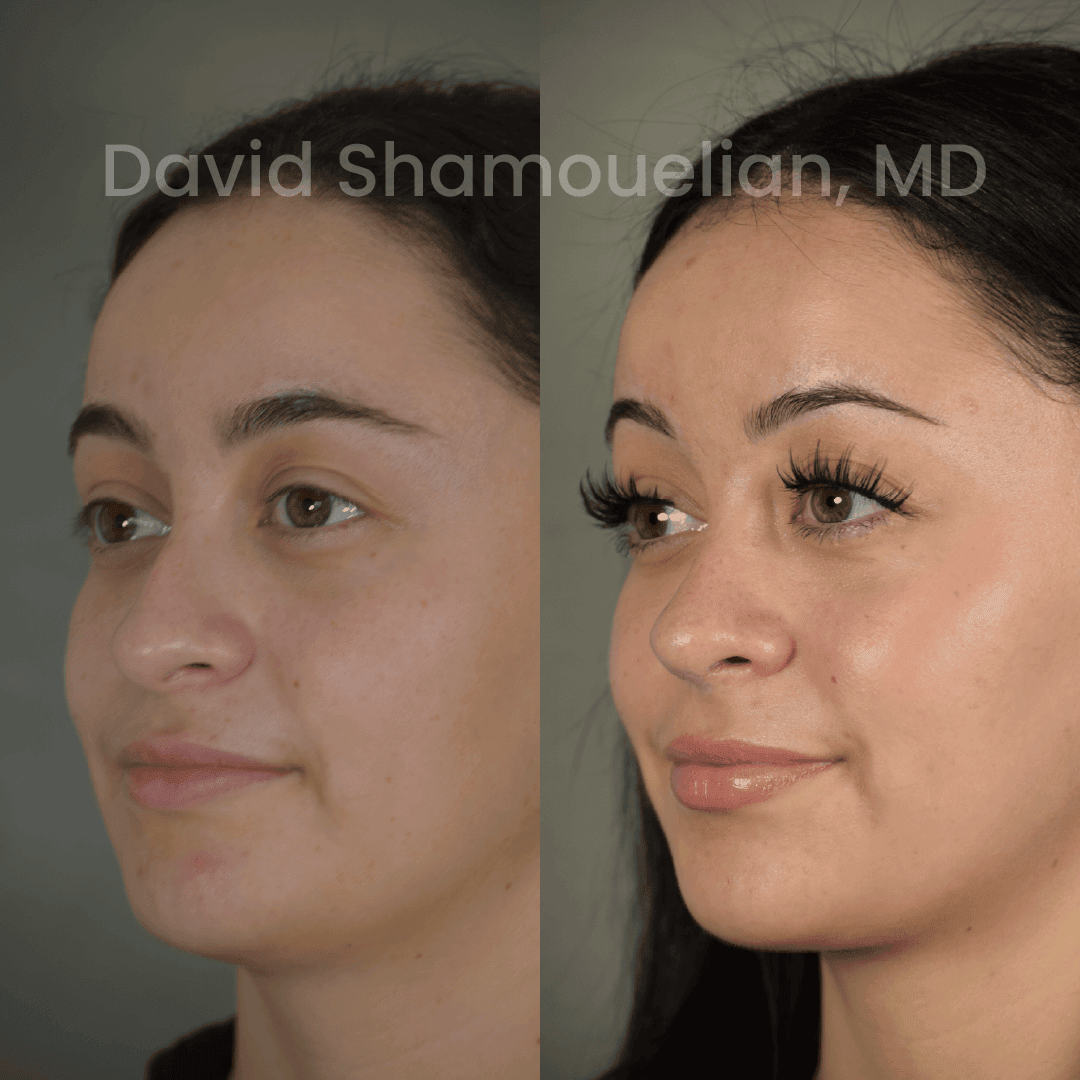 Allure BH Before After Rhino Pt 50