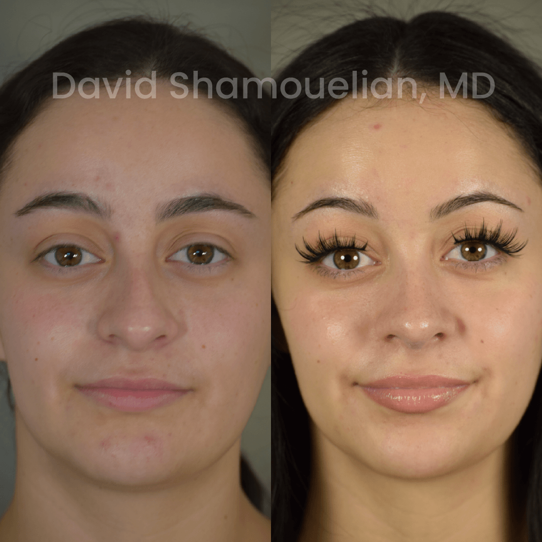 Allure BH Before After Rhino Pt 50