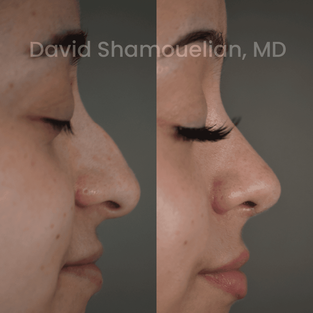 Allure BH Before After Rhino Pt 50