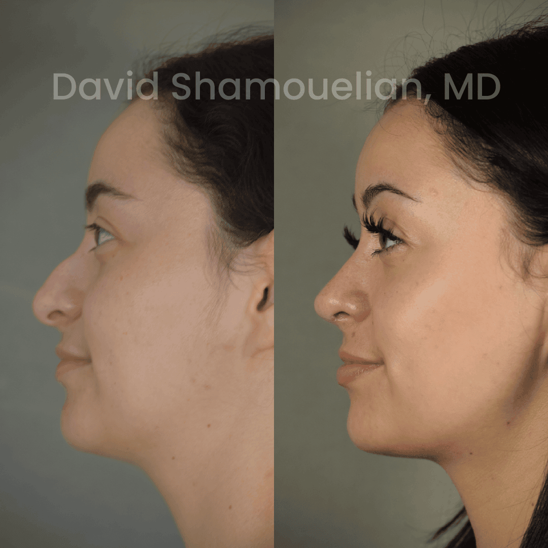 Allure BH Before After Rhino Pt 50