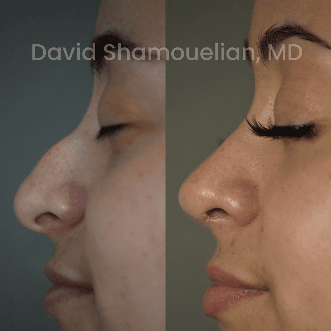 Allure BH Before After Rhino Pt 50