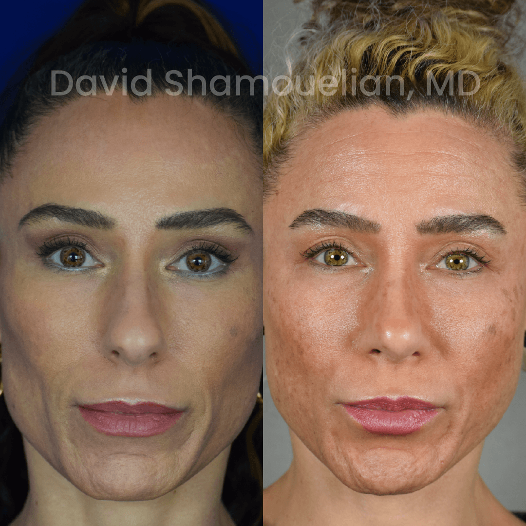 Allure BH Before After Rhino Pt 51