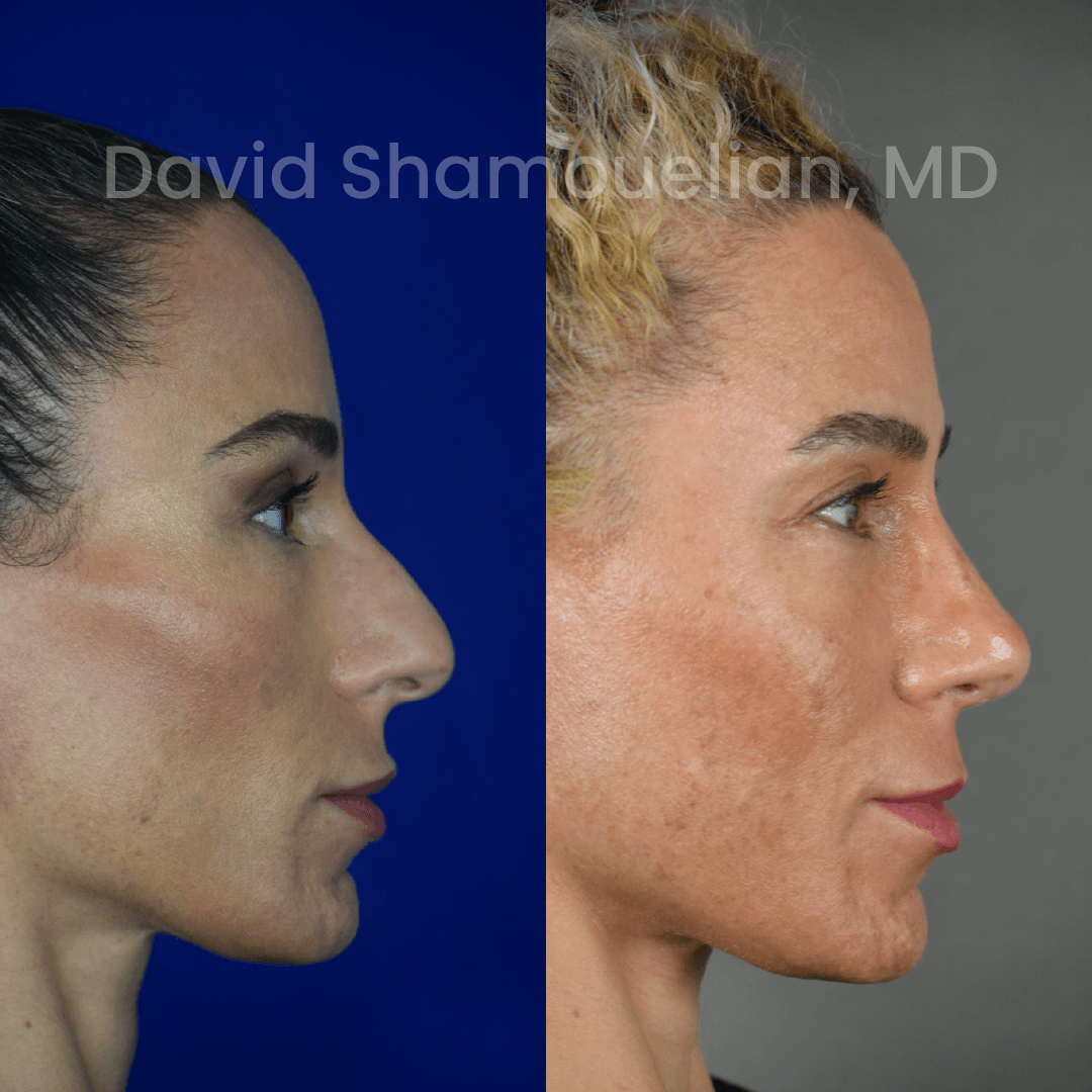 Allure BH Before After Rhino Pt 51