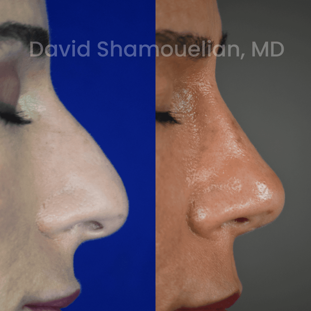 Allure BH Before After Rhino Pt 51