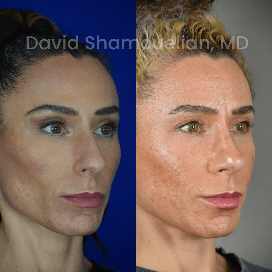 Allure BH Before After Rhino Pt 51