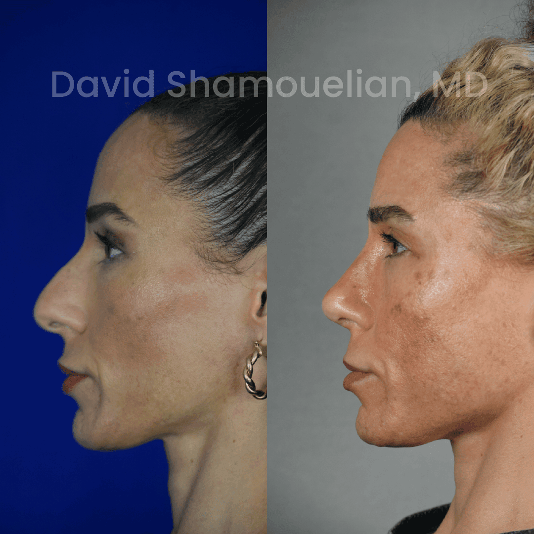 Allure BH Before After Rhino Pt 51