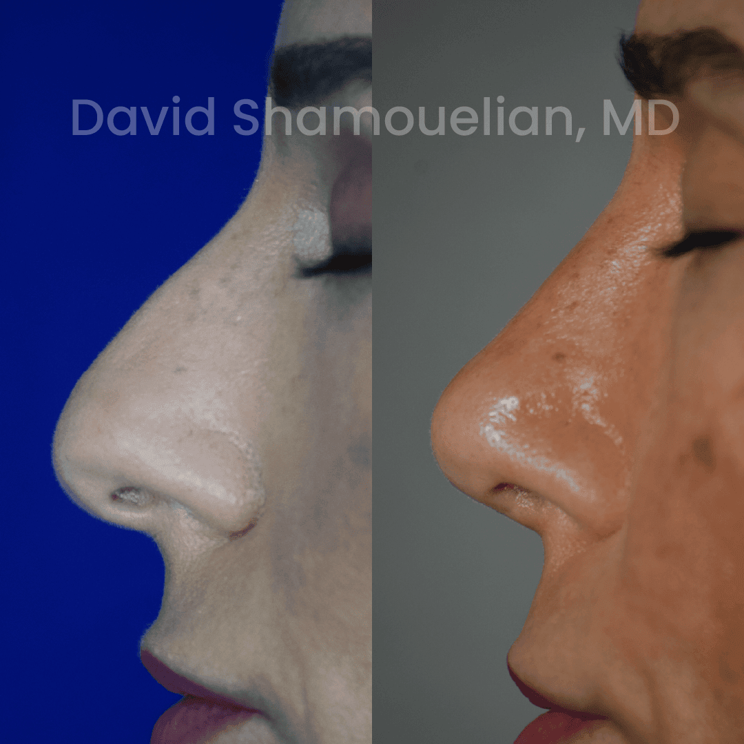 Allure BH Before After Rhino Pt 51