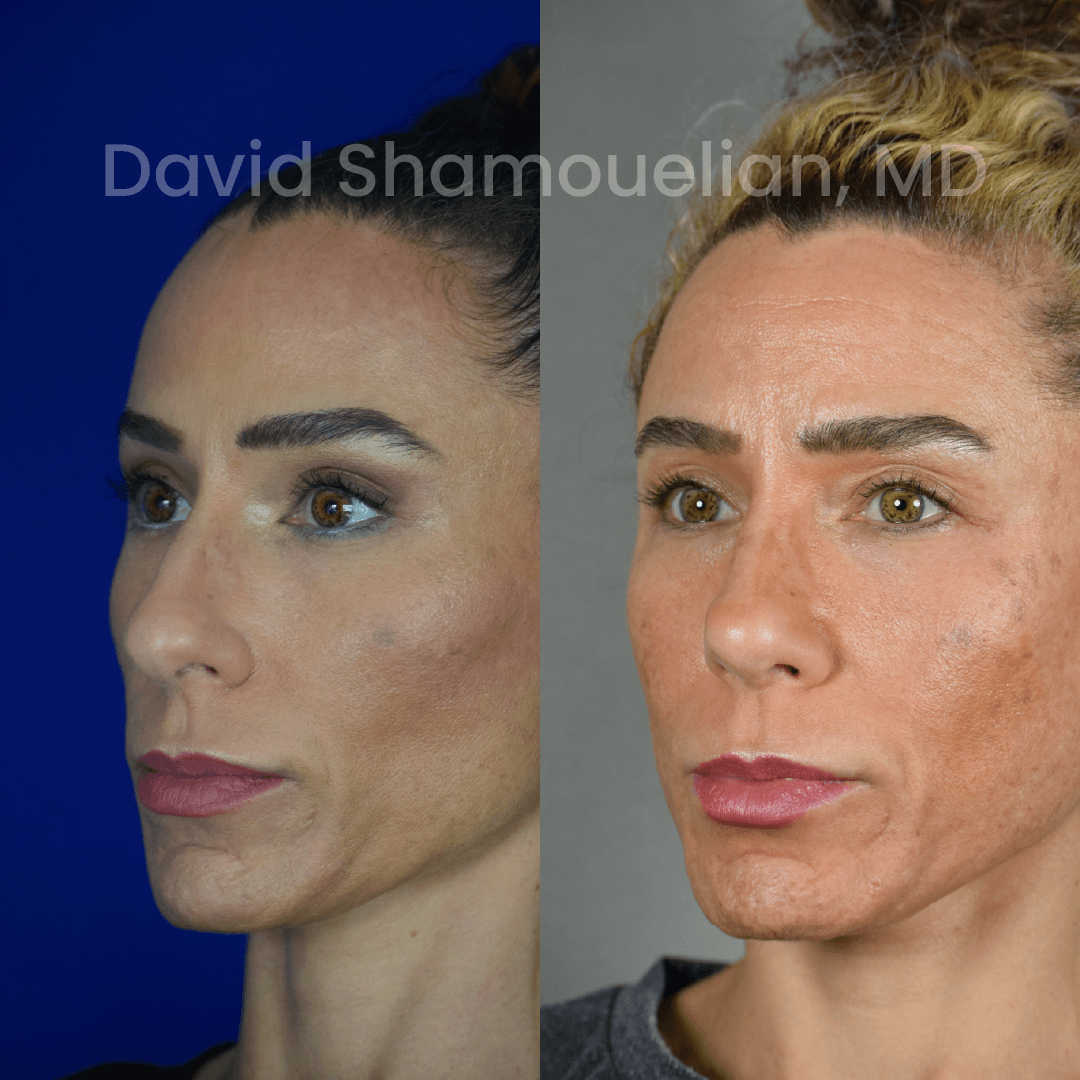 Allure BH Before After Rhino Pt 51