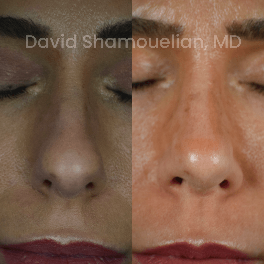 Allure BH Before After Rhino Pt 51